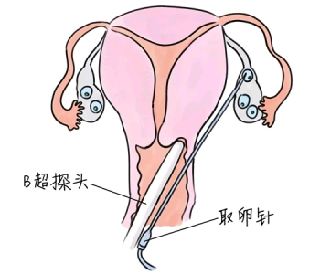 小儿退烧推拿手法 5种嘉兴捐卵宝宝退烧按摩方法